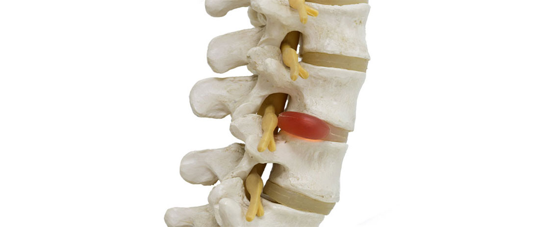 Diagram of herniated disc in spinal cloumn
