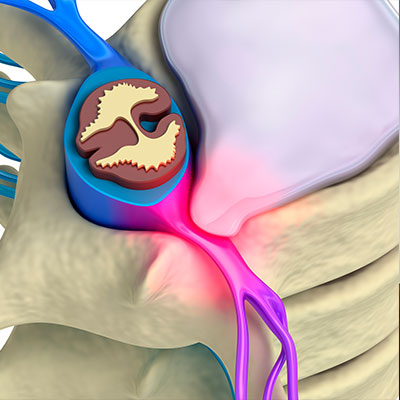 Diagram of herniated disc in Livermore