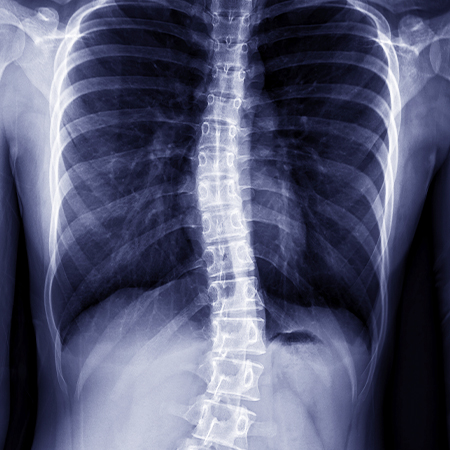 X-ray of spine with scoliosis in need of chiropractic care in Livermore